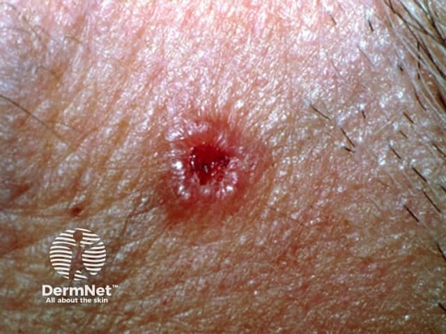 Example of Basal Cell Carcinoma