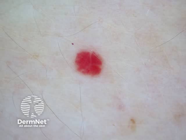Example of a haemangioma