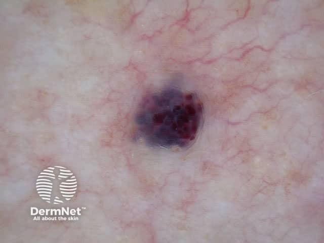 Another example of a haemangioma