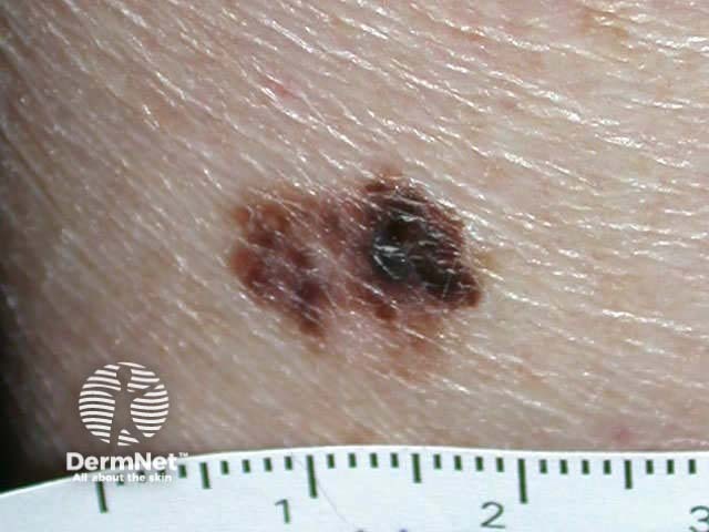 Example of a melanoma