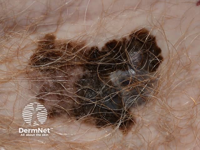 Another example of a melanoma
