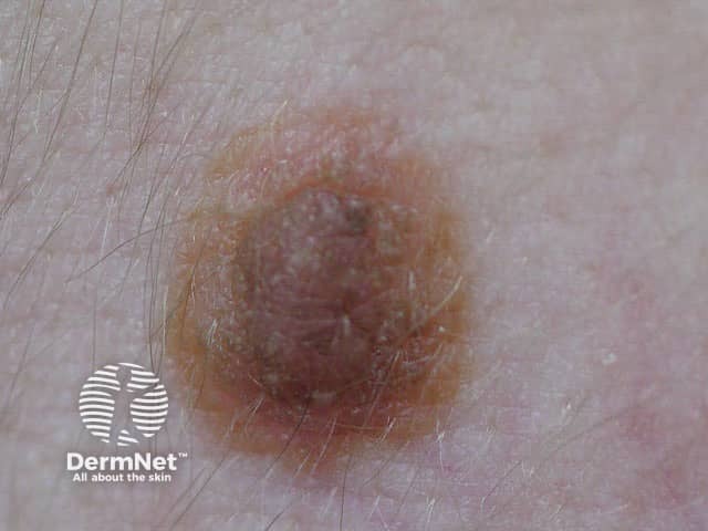 Example of a harmless mole