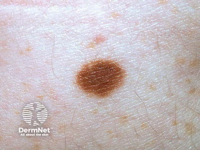 Example of a harmless mole