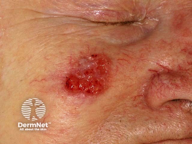 Example of Squamous Cell Carcinoma