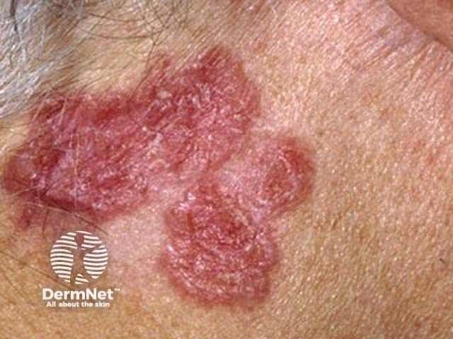 Example of Squamous Cell Carcinoma