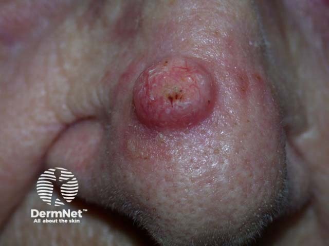 Example of Squamous Cell Carcinoma