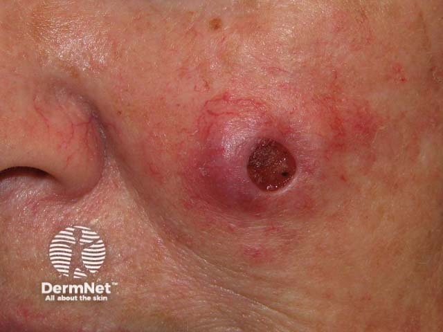 Example of Squamous Cell Carcinoma