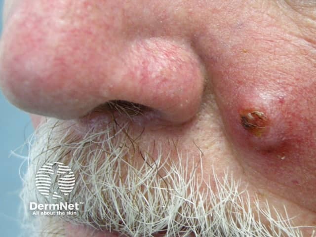 Example of Squamous Cell Carcinoma