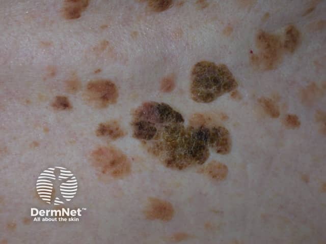 Example of a Seborrhoeic Keratosis