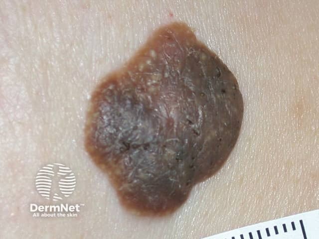 Another example of a Seborrhoeic Keratosis